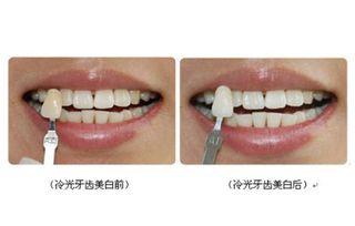 爆料牙齿美白是真的吗视频,视频爆料揭示真实效果  第1张